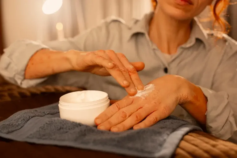 Mains Gercées et Abîmées