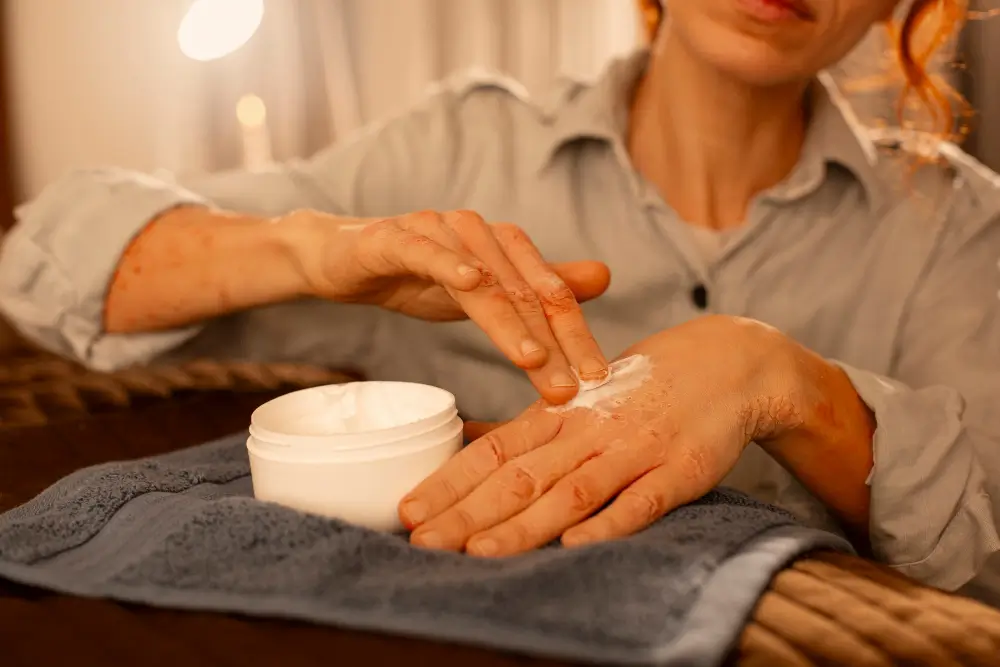 Mains Gercées et Abîmées